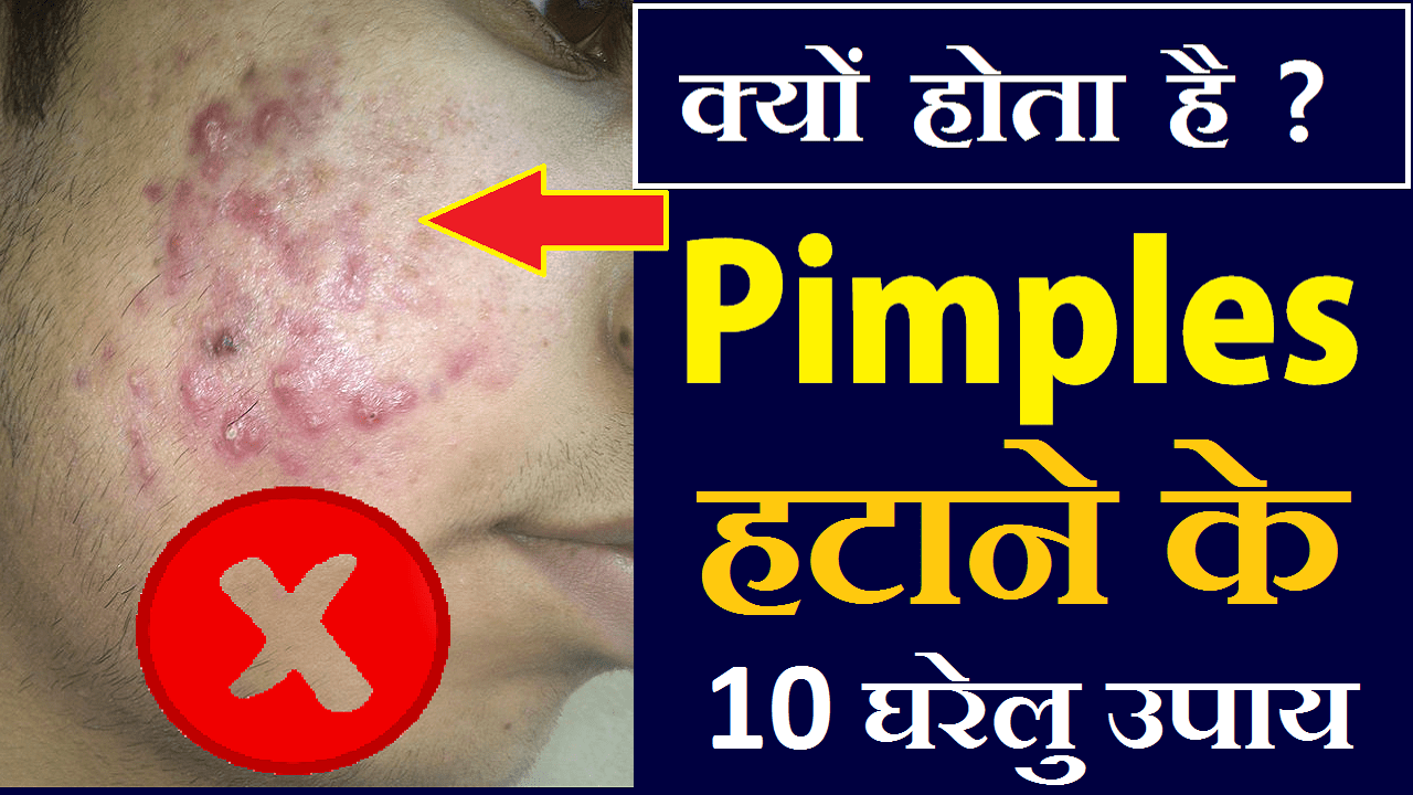 Pimples-Kaise-Hataye